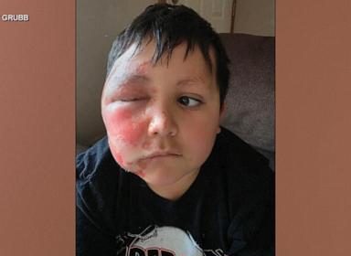 WATCH: Mom shares warning after son is severely burned following social media trend