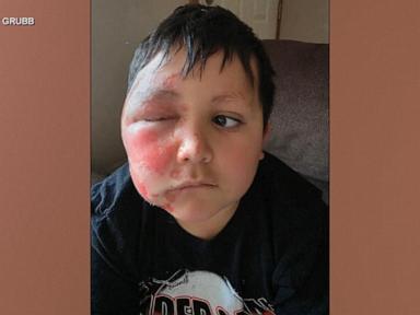 WATCH:  Mom shares warning after son is severely burned following social media trend