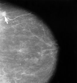 Las Vegas breast cancer survivor receives ‘horrifying’ letter. Her last 3 mammograms aren’t valid